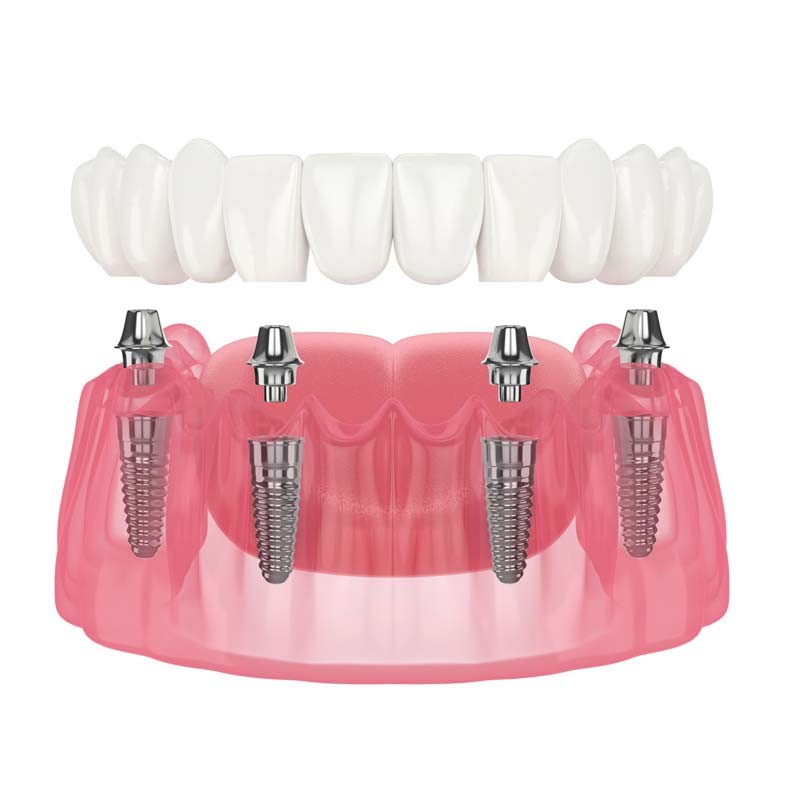 All on 4 快速一日植牙