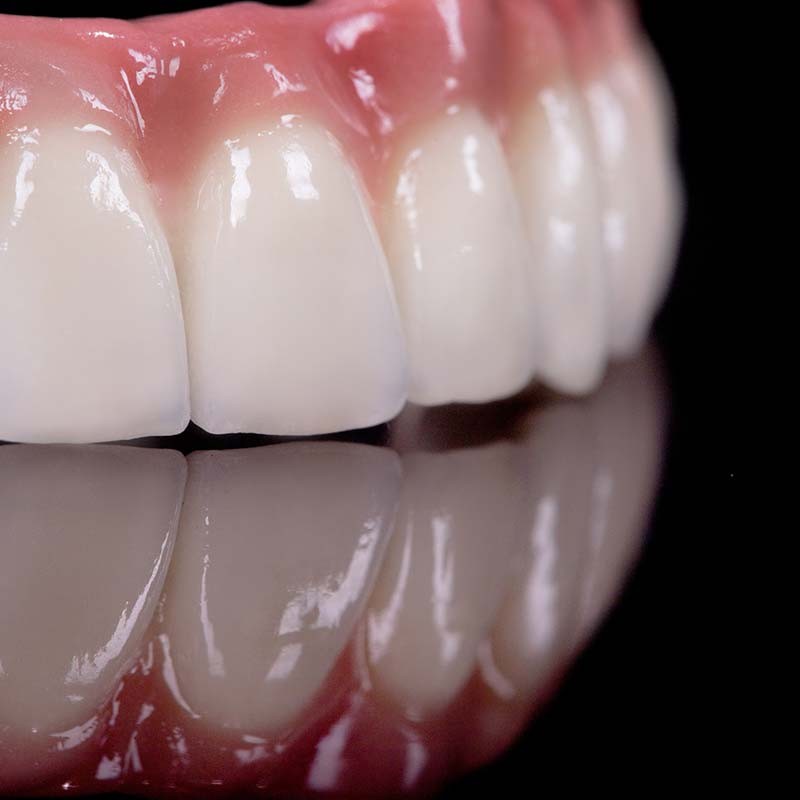 數位化全瓷牙套